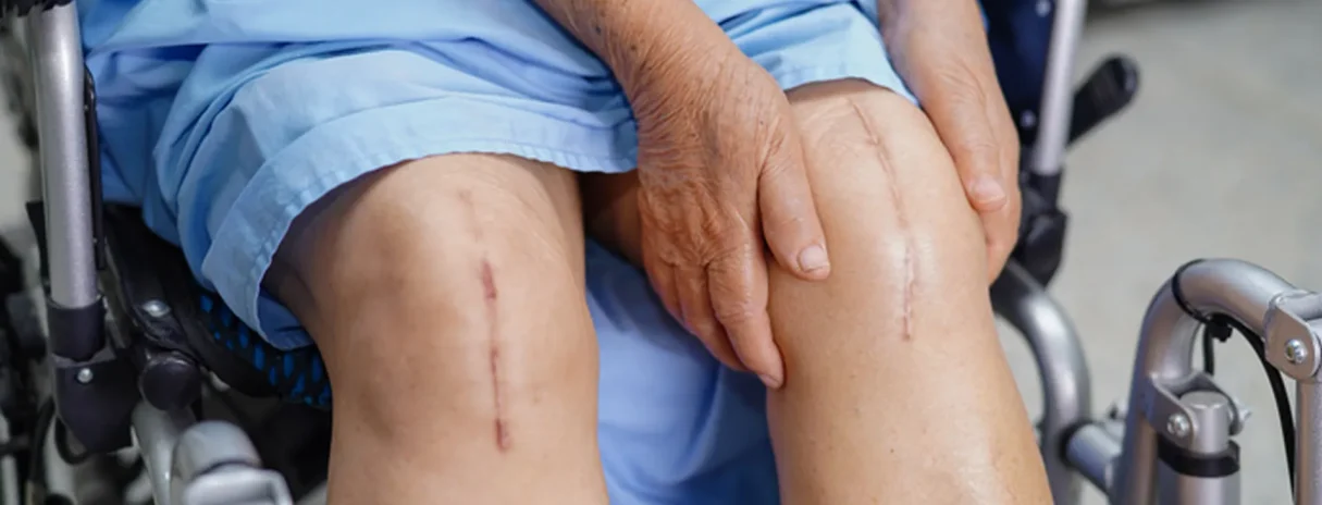 knee replacement recall